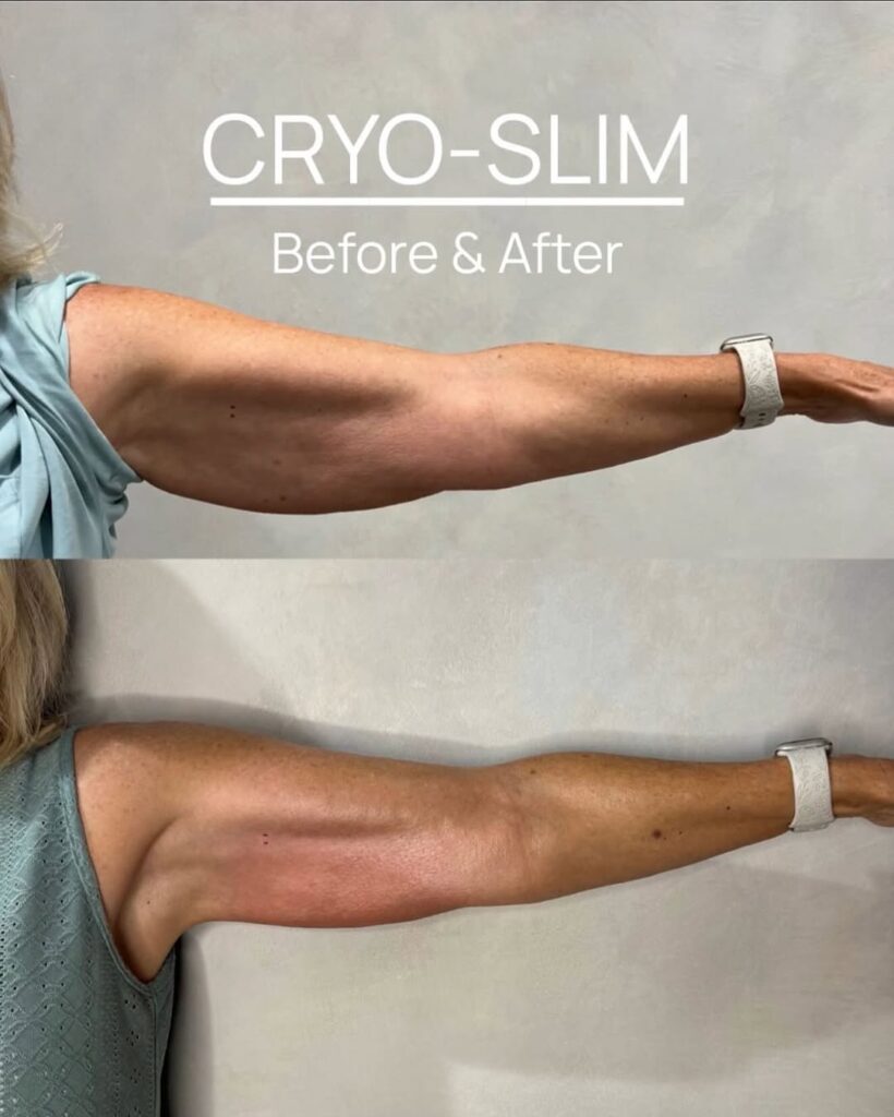 lichaamscontouring via cryolipolyse: voor en na