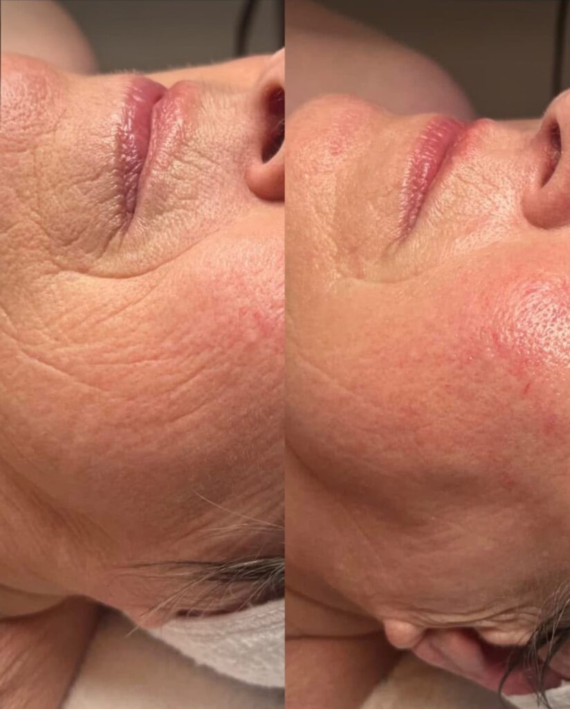 Effect voor en na van cryolipolyse